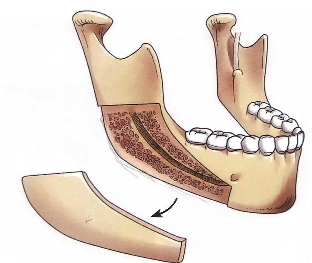 今天给大家讲讲劈外板,从矢状面劈开并截除下颌角区(含部分下颌支与