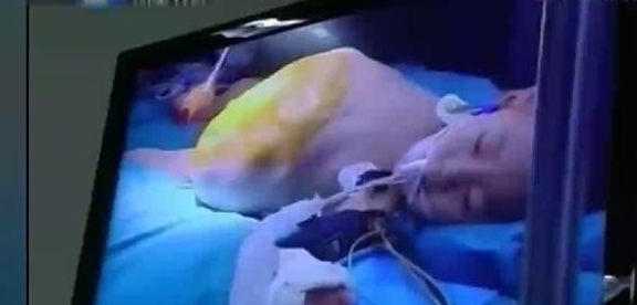 原创1岁半女童身怀9斤"死胎",手术医生刚切开肚子:自己就蹦出来了