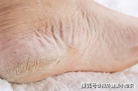 原创肝好不好,脚先知?肝好的人,脚上一般没有4异常,愿你全无