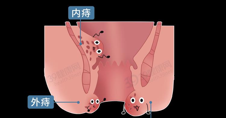 排便时,肛门掉出一块肉是怎么回事?这5类人易被"脱肛"