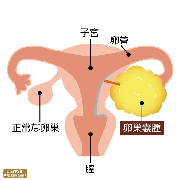 jmt日本医疗-子宫肌瘤卵巢囊肿具体是什么疾病?