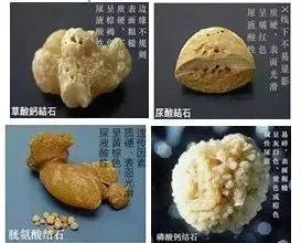 结石的成分主要有6种,按占比例高低为草酸盐,磷酸盐,尿酸盐,碳酸盐,胱