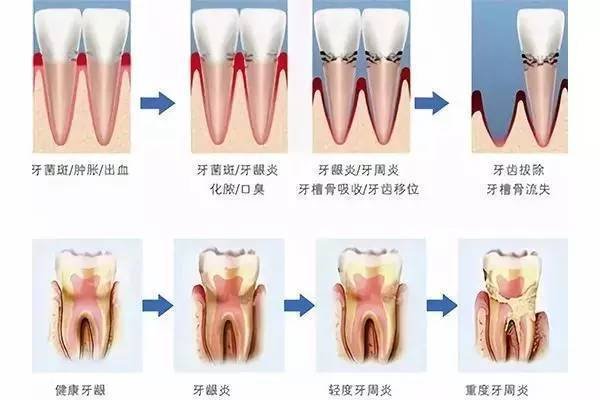 为啥种牙前医生让你先治牙周病 看完你就懂了