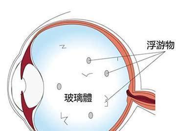 2,玻璃体液化及后脱离