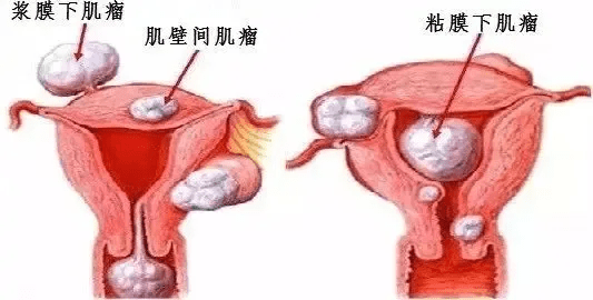 根据子宫肌瘤生长的位置,可以分为 肌壁间肌瘤,浆膜下肌瘤,黏膜下