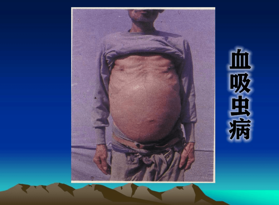得了血吸虫病的症状