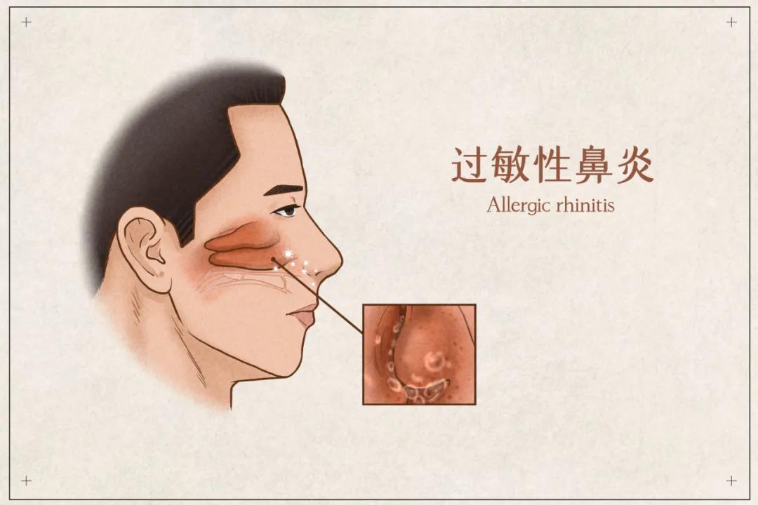 原创鼻炎"生事"季,如何让鼻子通气舒畅?吸氢试试!