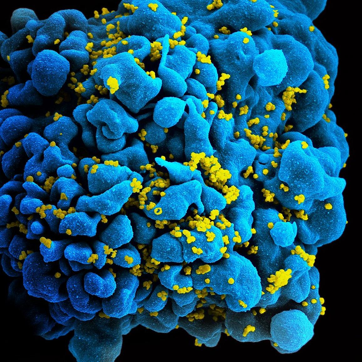 感染 hiv 的 t 细胞的扫描电镜图.国际开发署