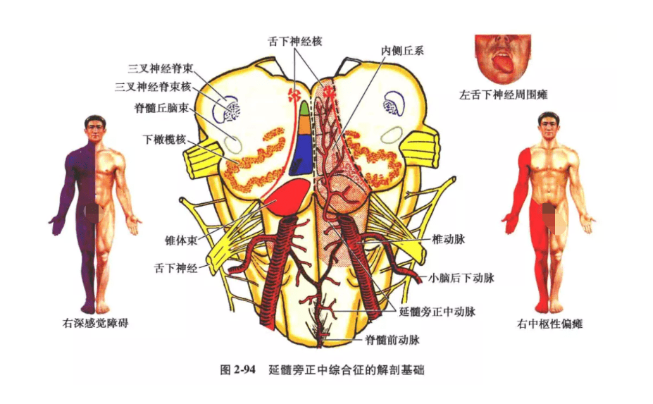 此外,由脊髓前动脉发出的延髓旁正中动脉闭塞时,有时可产生交叉性上