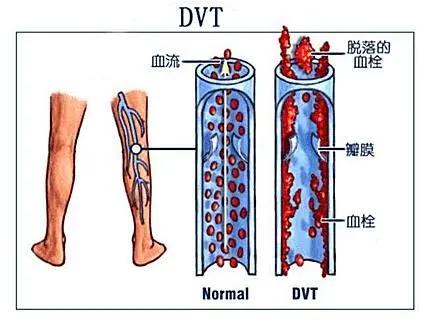 下肢深静脉血栓形成(deep venous thrombosis,dvt)是其中的高发类型.