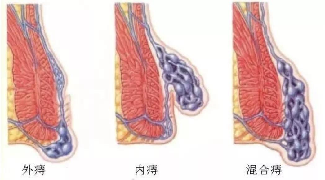 相信您一定见过有些人小腿上的静脉曲张吧,痔疮与之类似,其实就是长在