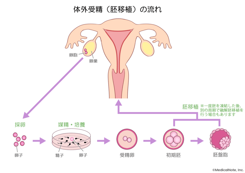 jmt日本医疗-不孕症的治疗主要包括时机,人工授精和体外受精