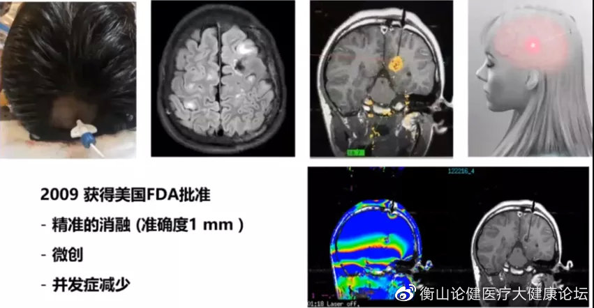 癫痫外科未来的方向 01,定位方法 1,分子影像 2,无创高频脑电图,脑磁