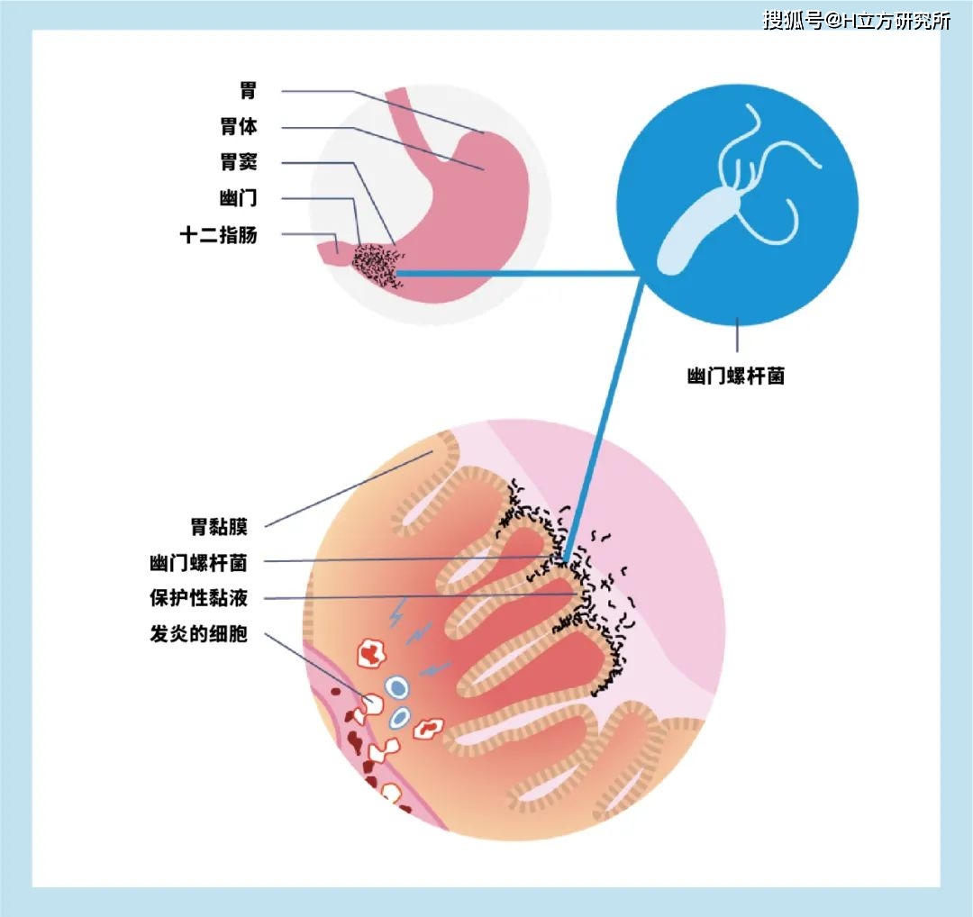 研究发现,幽门螺杆菌最喜欢呆的位置是胃小弯,胃窦及幽门区域,最早也