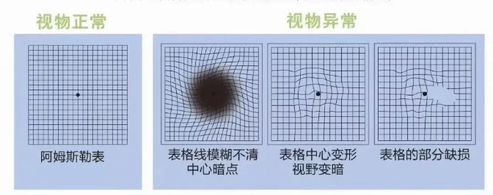 眼睛黄斑不是斑引发黄斑病变的因素揭示