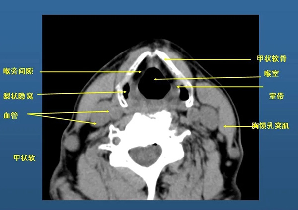 喉ct检查,适用于了解喉部及周围的组织解剖关系.