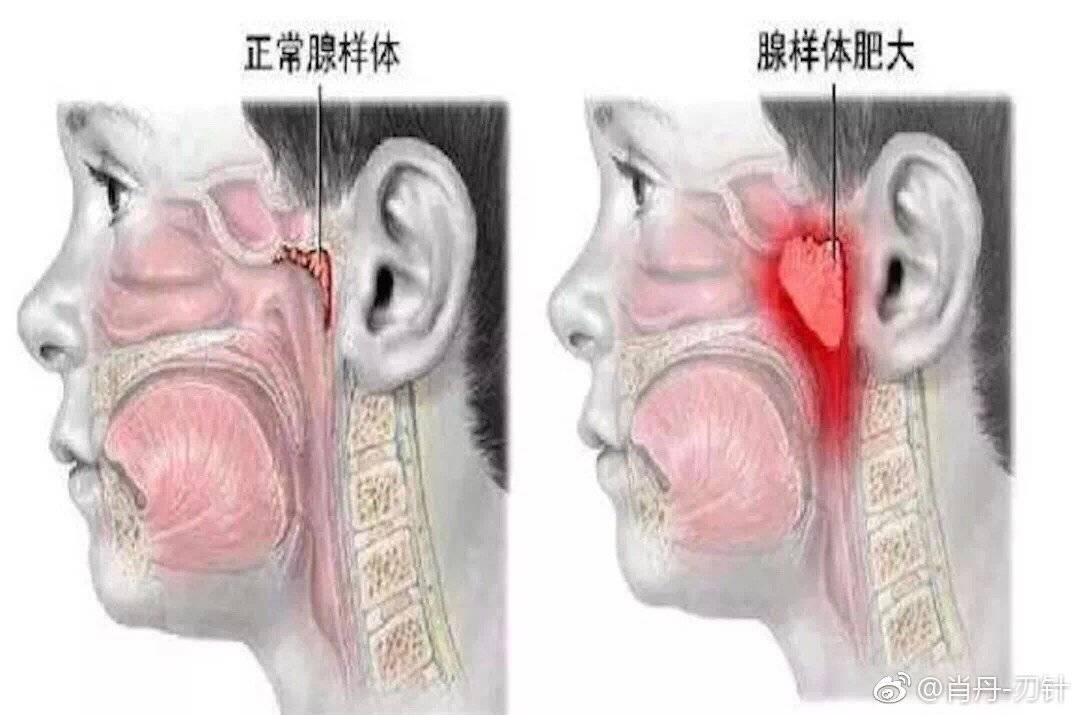 点石师爷王永月医生详谈儿童腺样体肥大