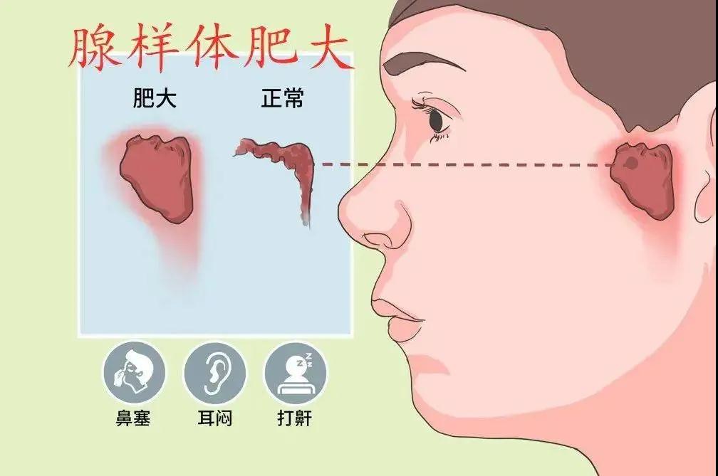 (点石师爷)王永月医生教你正确认识儿童腺样体肥大