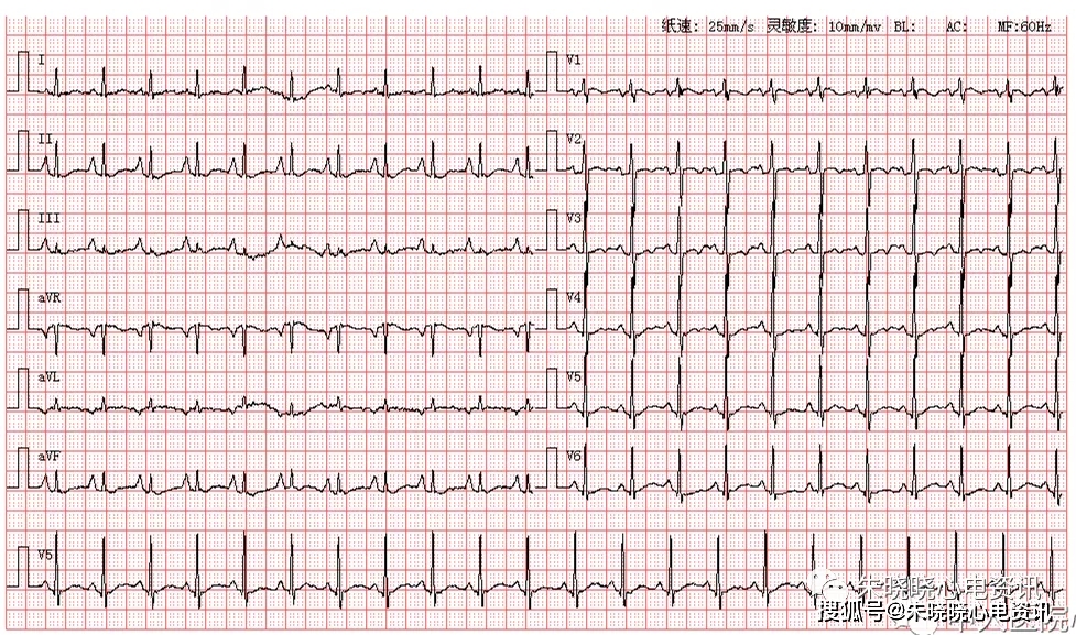 患者男,63岁,因胸闷气喘来医院就诊,图为其入院体检心电图