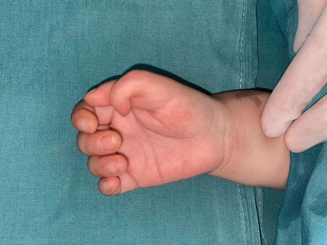 乐乐双手多指均为wassel分型Ⅳ型,但是两者又不完全相同,左拇指多指