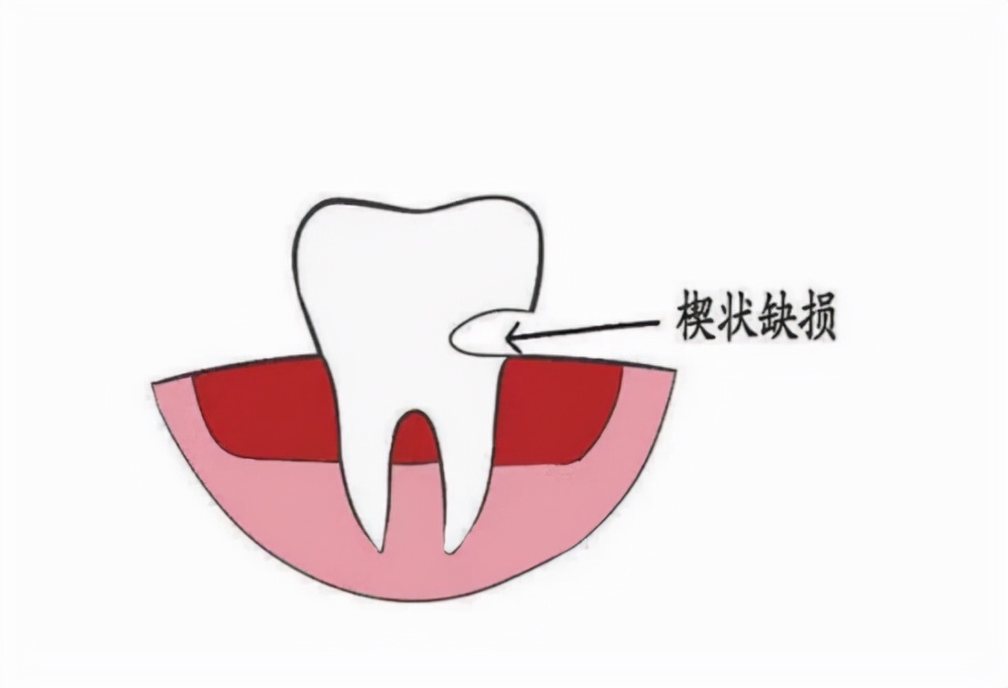 牙齿楔状缺损可以用电动牙刷吗超级伤牙的四大误区