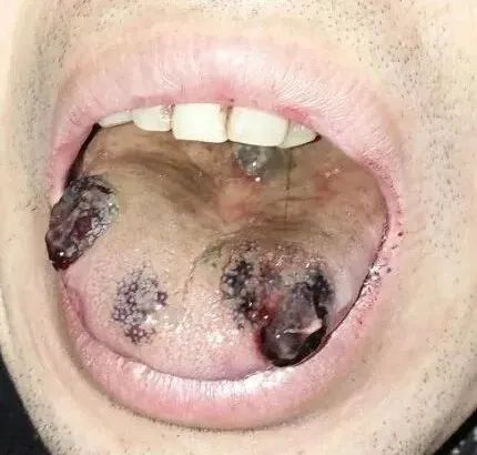 甘草学园舌疮舌癌三甲医院要求病检却不知五付中药患者痊愈