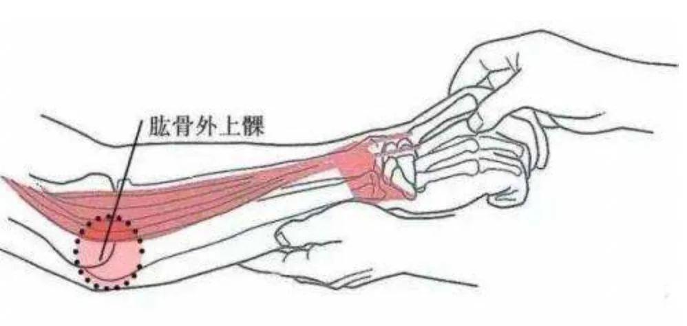肱骨外上髁是腕伸肌(即负责把手腕抬起来的肌肉)以及手指伸肌(即负责
