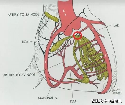 一图详解急性心肌梗死的判读
