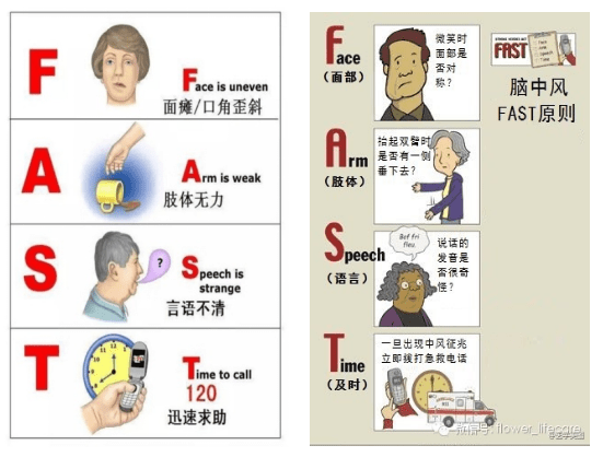 警惕卒中症状尽早识别救治