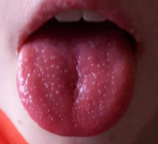 这种舌象常见于湿气重,湿热明显的孩子,儿科临床中的常见疾病有川崎病
