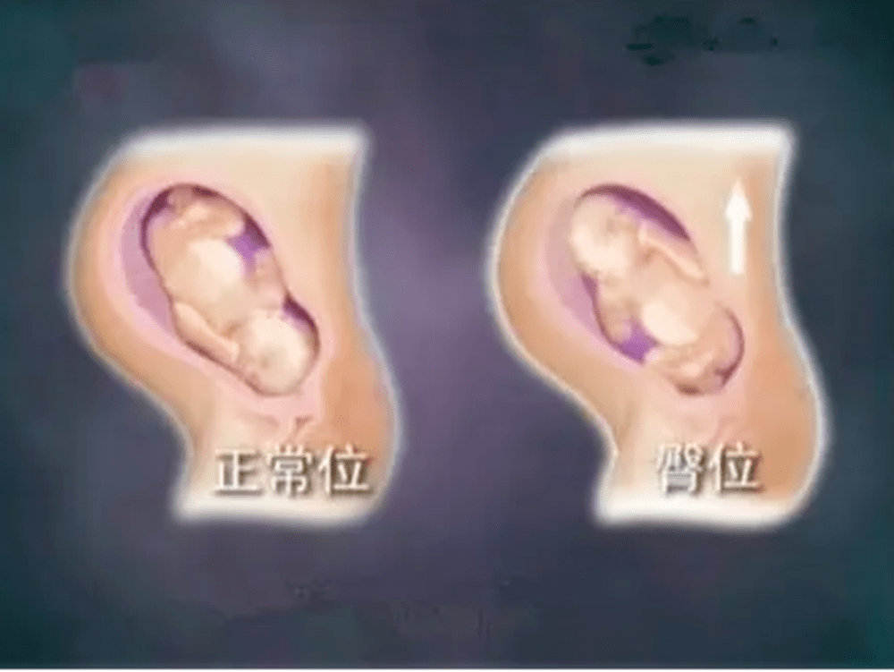 孕期胎儿一直处于＂臀位＂,会影响以后腿部发育？医生给出答案