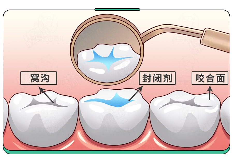 没有比看牙更＂烧钱＂的事了！这个防龋齿方法,娃3岁起就要做！