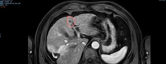 原创体检发现小结节再检竟然是肝癌结节有这样的表现一定要警惕