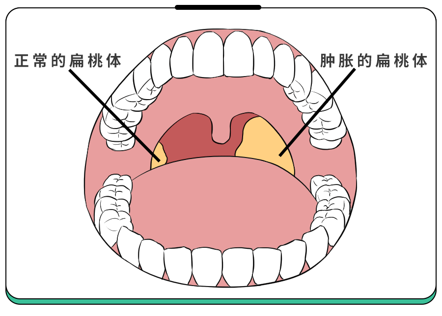 孩子扁桃体发炎咋护理？宝妈群竟疯传这种小零食止痛,专家也点赞