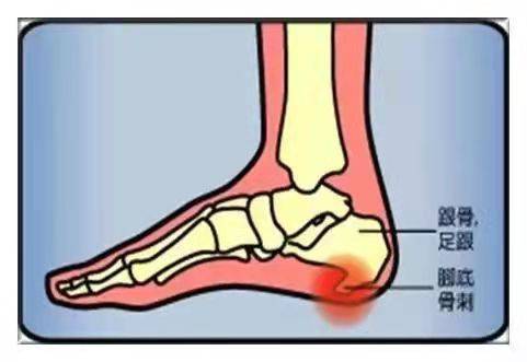 跟腱炎会有什么症状跟腱疼痛始于运动中或运动后,且疼痛的程度逐渐