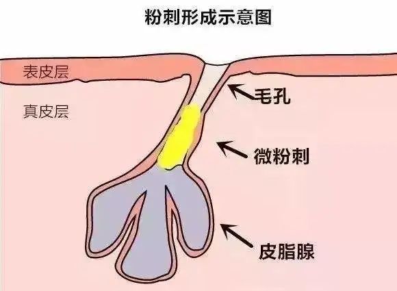 粉刺栓中含有的主要成分有皮屑,皮脂以及马拉色菌等细菌,而且多数粉刺