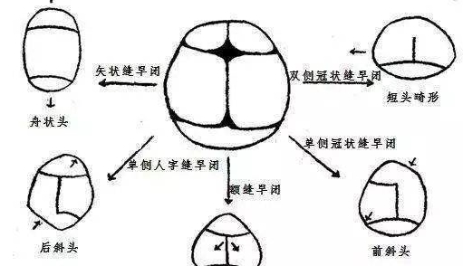 这种病影响孩子头部发育_颅腔_头颅_畸形