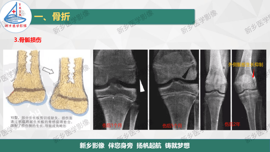 骨骺损伤及常见各类骨折的分型及诊断_平台_传播_声明