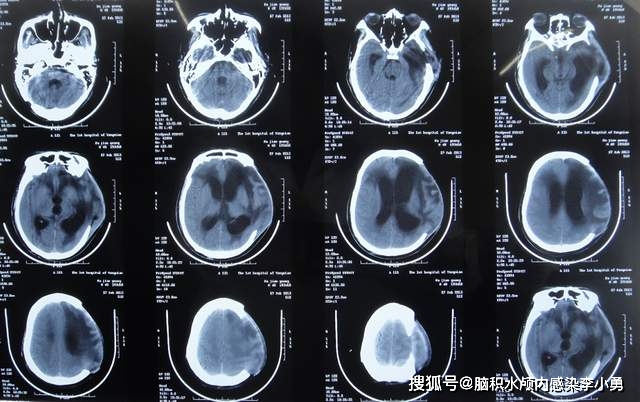 图-10:2013年2月27日头颅ct因脑积水和脑膨出反复,该院没有更好的办法