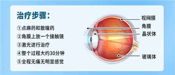 例如:裂隙灯,散瞳检查,眼底照相,眼部b超等,符合飞蚊症激光治疗指征的