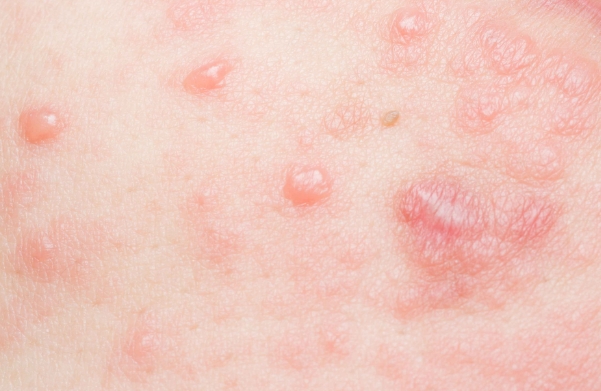 皮肤的损害呈现出多种情况;比如瘙痒,红斑,水泡等;淋巴癌晚期