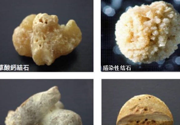 草酸钙结石最常见,还有磷酸盐,尿酸盐,碳酸盐结石,胱氨酸结石罕见.