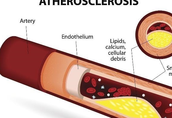 动脉硬化不是老年人的专属，糖尿病人更易得，饮食预防是关键