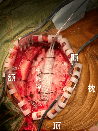 重庆首例运动皮层刺激疗法治疗丘脑卒中后痛苦悲伤案例