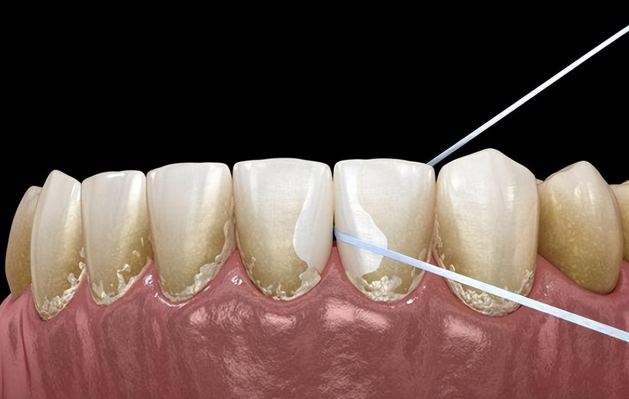 “牙结石”能够本身抠掉吗？学会那几招，牙缝脏工具或能够轻松掉
