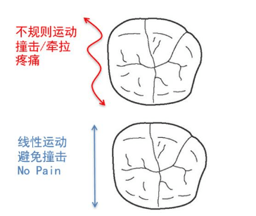 新合生瑞士索菲亚GBT洗牙 龈上龈下双管齐下