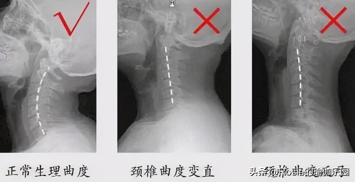 墨珠成婚文雅诱人，若何拥有同款美肩仙女背？3步美肩背护颈椎