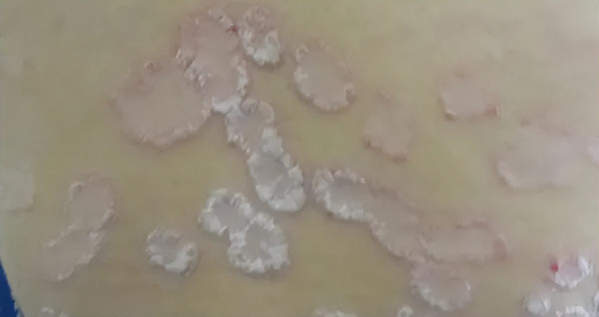 常见的几种女性皮肤病，你中招了吗？