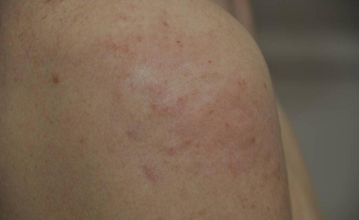 「科普」6种常见的皮肤病，教你区分它们的症状和发病原因