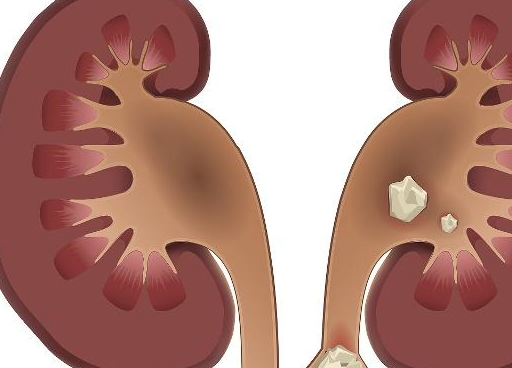饮食上有这三个习惯你也b体育许比别人更易患上肾结石望周知(图2)